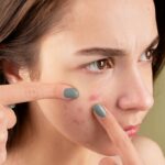 how to cure acne naturally in 3 days