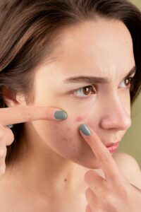 how to cure acne naturally in 3 days